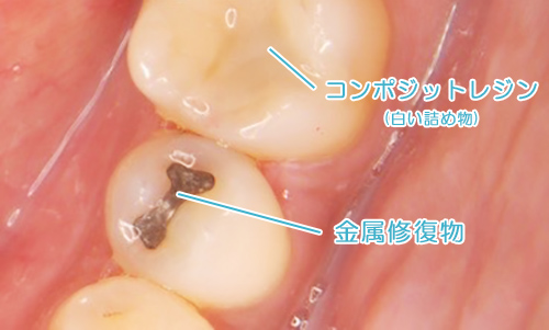 コンポジットレジン