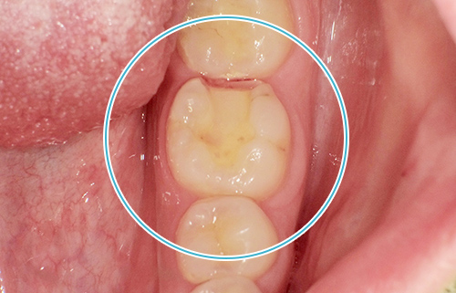 セラミックの詰め物 治療前