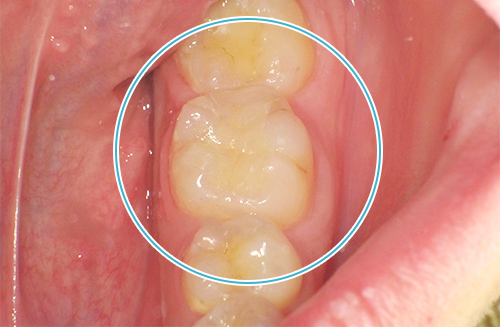 セラミックの詰め物 治療後