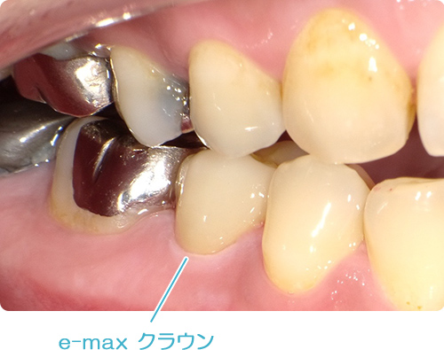 自費の被せ物 e-max クラウン