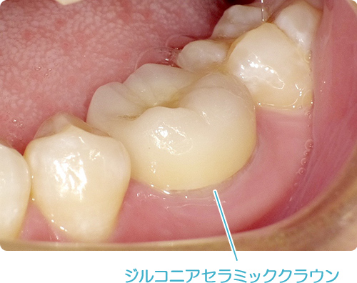 自費の被せ物 ジルコニアセラミッククラウン