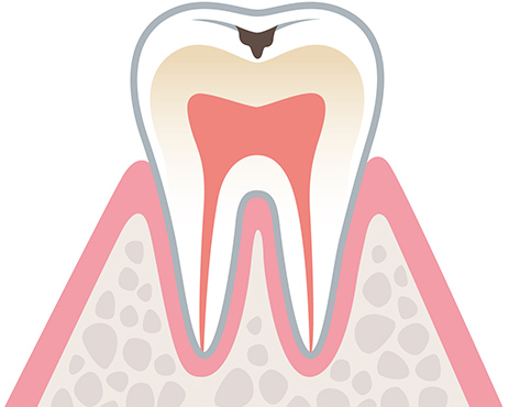 虫歯の初期症状