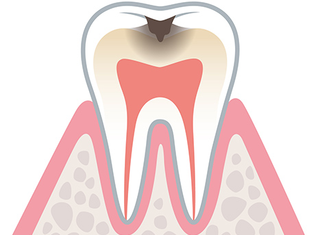虫歯の末期症状